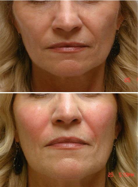 And Placement Of Temporary Dermal Fillers Nurse Key And Placement Of Temporary Dermal Fillers Nurse Key