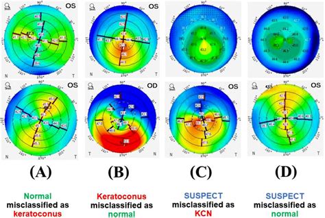 Anterior Sagittal Curvature Maps Of Eight Eyes That Were Misclassified Anterior Sagittal Curvature Maps Of Eight Eyes That Were Misclassified