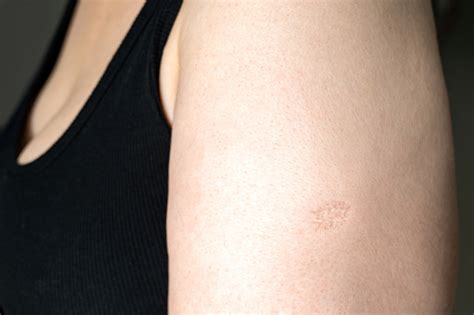 Bcg Or Tb Vaccine Scar Marks Monkeypox And Smallpox Vaccines On A Bcg Or Tb Vaccine Scar Marks Monkeypox And Smallpox Vaccines On A