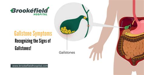 Can You Recognize A Gallstone Dhp Digestive Health Partners