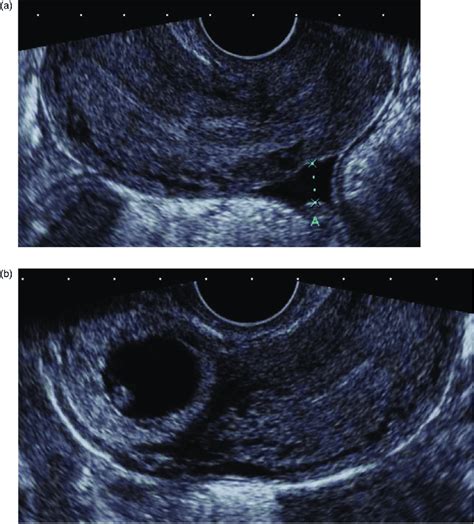 Clinical Concepts In Pelvic Ultrasound Taming The Sru Clinical Concepts In Pelvic Ultrasound Taming The Sru