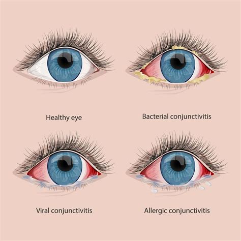 Conjunctivitis Eye Doctor Verified 4 Best At Home Treatments Conjunctivitis Eye Doctor Verified 4 Best At Home Treatments
