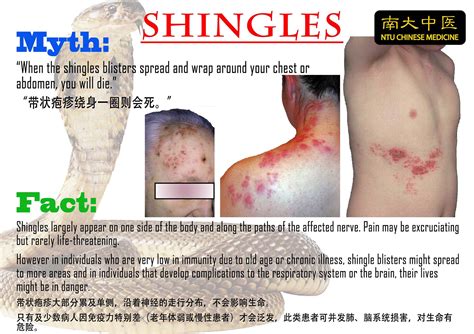 6种带状疱疹凉水澡方法