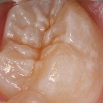 Deep Grooves In Healthcare
