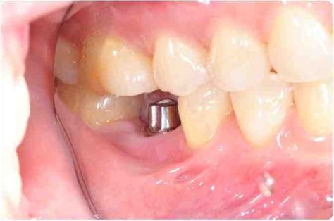 Does The Army Do Dental Implants Dental News Network Does The Army Do Dental Implants Dental News Network