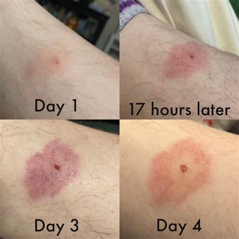 Does This Look Like A Bullseye Rash To Anyone I M Not Really Sure R Does This Look Like A Bullseye Rash To Anyone I M Not Really Sure R