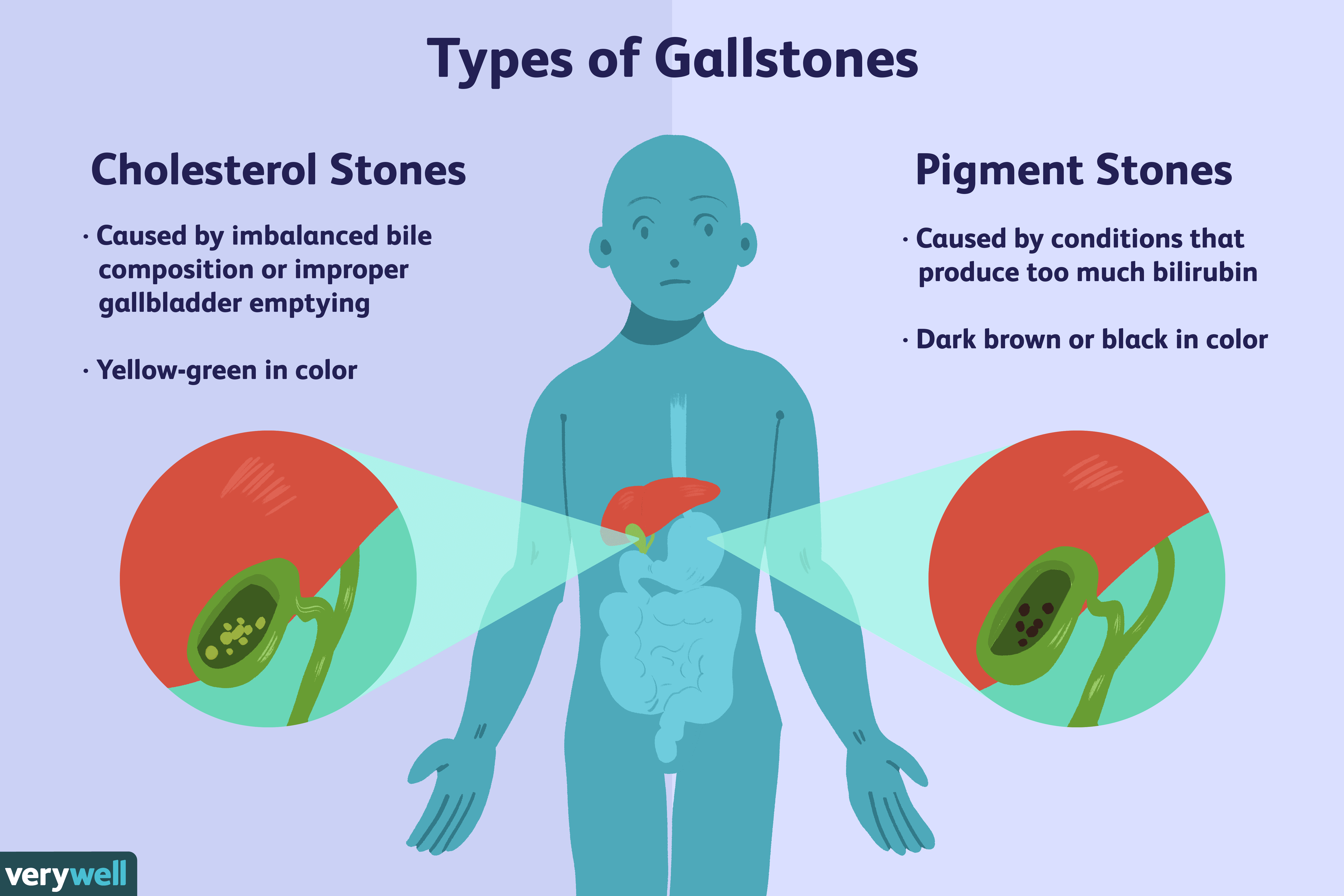 Gallstone Ultrasound Radiology At St Vincent S University Hospital Gallstone Ultrasound Radiology At St Vincent S University Hospital