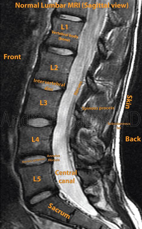 How To Read An Mri Of The Lumbar Spine