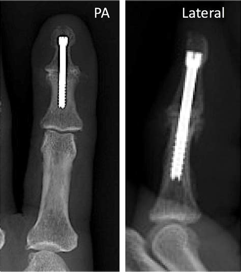 Index Finger Ip Joint Fusion Thomas R Hunt Iii M D D Sc Index Finger Ip Joint Fusion Thomas R Hunt Iii M D D Sc