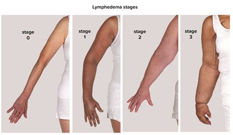 Lymphe What One Woman S Story Of A Side Effect Of Breast Cancer Lymphe What One Woman S Story Of A Side Effect Of Breast Cancer
