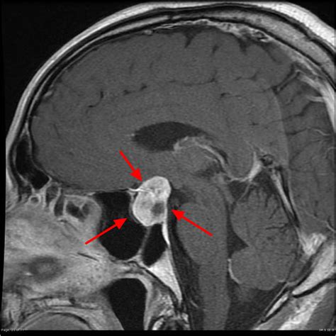 Pituitary Tumor Signs Symptoms Diagnosis Mri Surgery Treatment Pituitary Tumor Signs Symptoms Diagnosis Mri Surgery Treatment