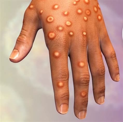 Pox Health Mo