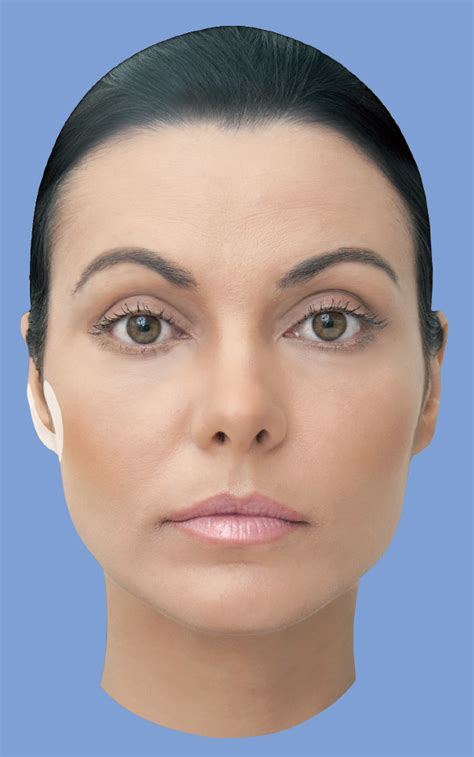 Preauricular Region Filler Placement Campus Sdh Preauricular Region Filler Placement Campus Sdh