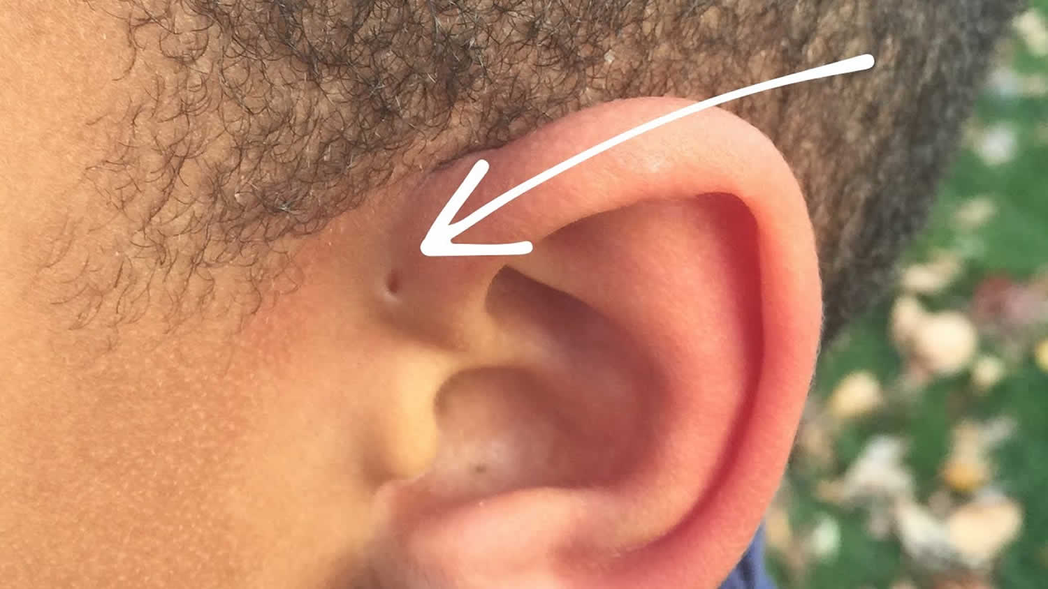 Preauricular Region Filler Placement