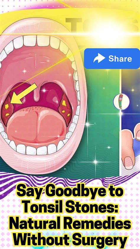 Say Goodbye To Tonsil Stones Easy Remedies Without Surgery Tonsil Say Goodbye To Tonsil Stones Easy Remedies Without Surgery Tonsil