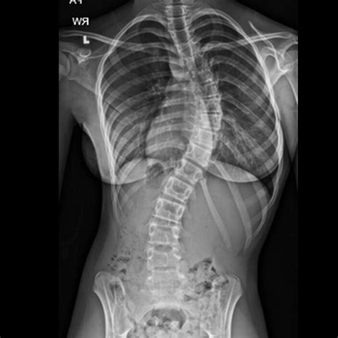 Scoliosis Scoliosis