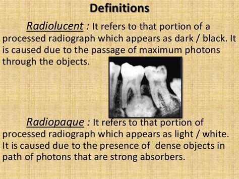 Simple Healthcare Definiton Of Radiopaque