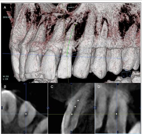 Three Dimensional Analysis Of Root Canal Curvature And Direction Of Three Dimensional Analysis Of Root Canal Curvature And Direction Of
