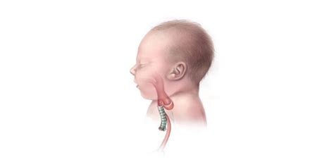 Tracheoesophageal Atresia Nursing Management Rnpedia Tracheoesophageal Atresia Nursing Management Rnpedia
