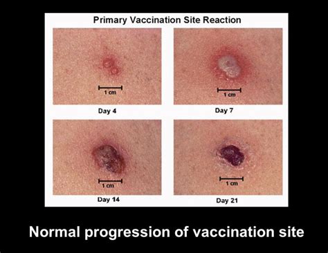 Tuberculosis Vaccine No Scar